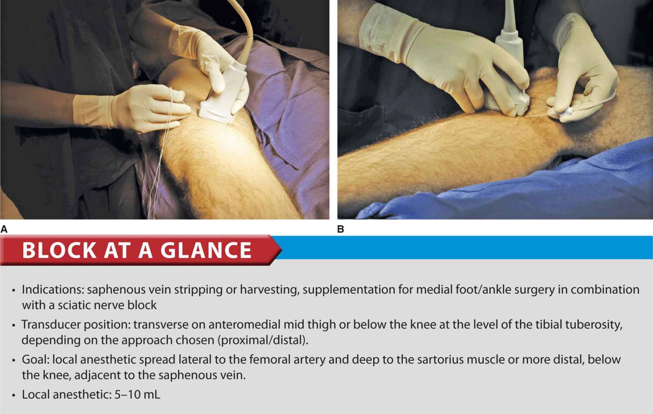 Ultrasound Guided Saphenous Nerve Block Hadzic s Peripheral Nerve 