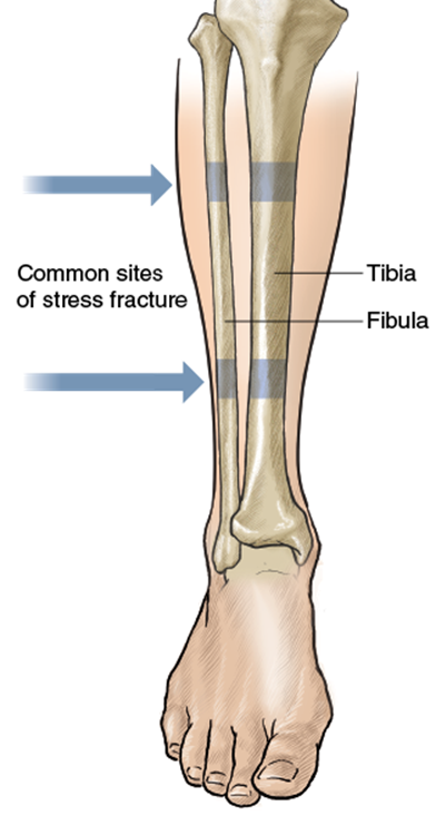 Figure 10.3 Common sites of stress fractures in the tibia and fibula.