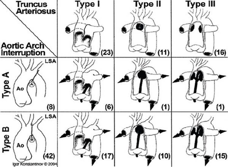 Truncus Arteriosus - Echocardiography in Pediatric and Adult Congenital ...