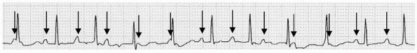 Atrioventricular Block - Basic and Bedside Electrocardiography, 1st ...