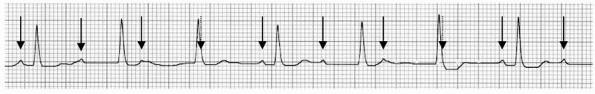 Atrioventricular Block - Basic and Bedside Electrocardiography, 1st ...