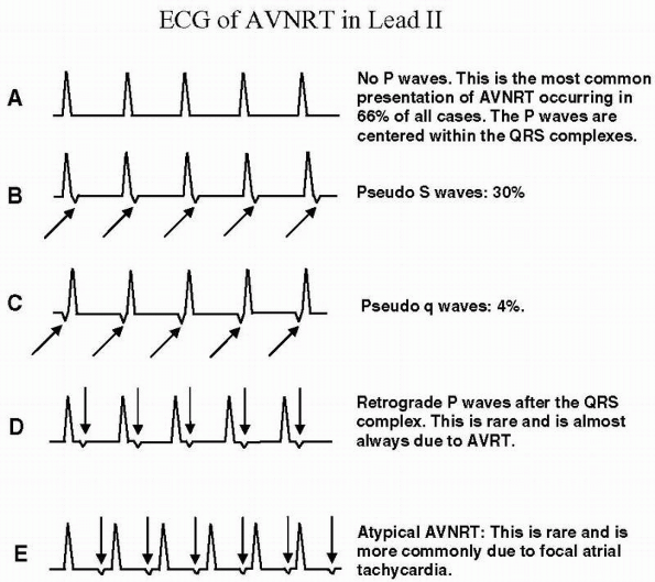 Supraventricular Tachycardia Due To Reentry Basic And Bedside 