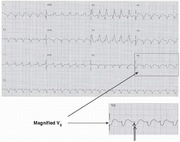 Wide Complex Tachycardia - Basic and Bedside Electrocardiography, 1st ...
