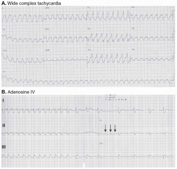 Wide Complex Tachycardia - Basic and Bedside Electrocardiography, 1st ...