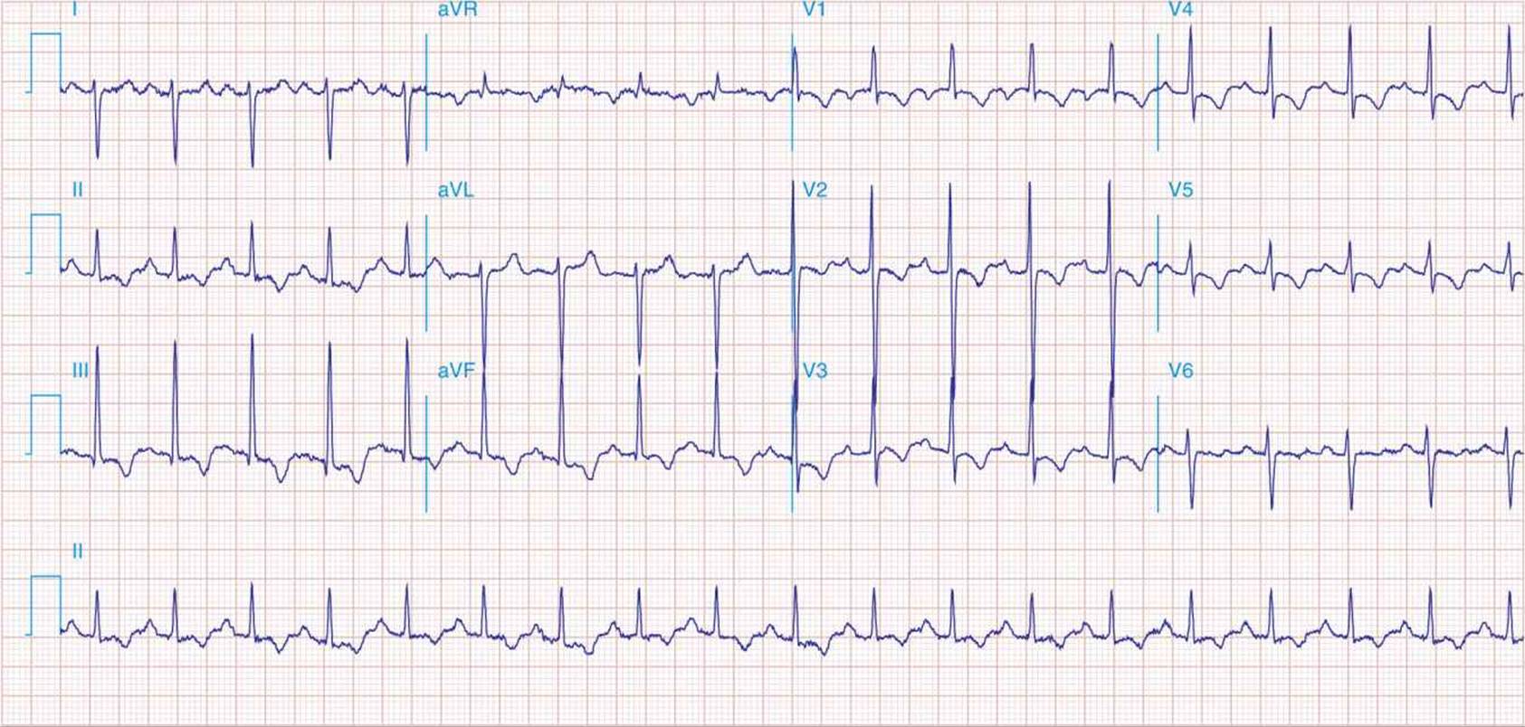 ATLAS OF ELECTROCARDIOGRAPHY - CARDIOVASCULAR ATLASES - Harrison's ...