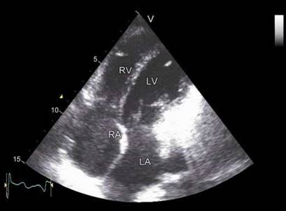 Echocardiographic Assessment of Right Ventricular Function: Methods and ...