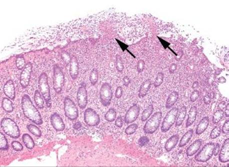 PSEUDOMEMBRANOUS PATTERN - COLON - Atlas of Gastrointestinal Pathology ...