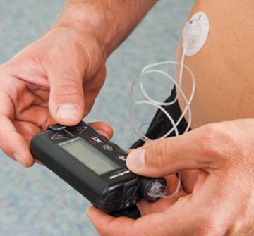 Figure 13.3 Insulin pumps are an alternate way to deliver insulin throughout the day.