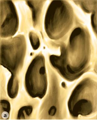 Figure 16.1 Normal and osteoporotic bone