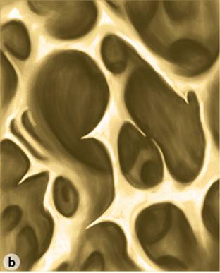 Figure 16.1 Normal and osteoporotic bone