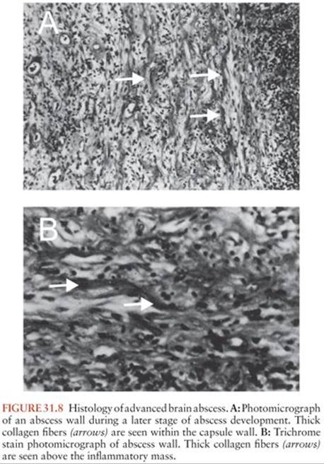 Brain Abscess - BACTERIAL AND MYCOPLASMAL - Infections of the Central ...