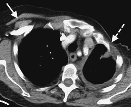 Unilateral Hyperlucent Hemithorax - Chest Radiology: The Essentials ...