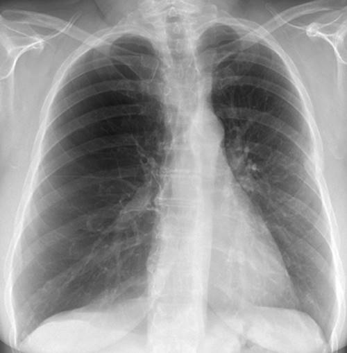 Unilateral Hyperlucent Hemithorax - Chest Radiology: The Essentials ...