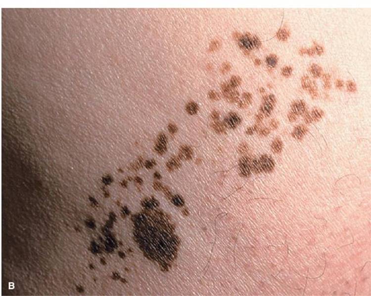 icd 10 melanotic macule Congenital of the Tongue: Report of Two Cases and Literature Review | Head and Neck Pathology Medical coding for lesions depends