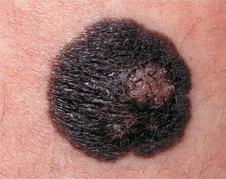melanotic macule icd 10 Pathology Outlines Malignant Melanoma of the Eyelid