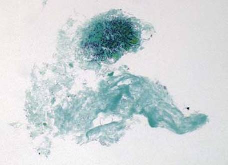 Actinomycosis - Thoracic Pathology: A Volume in the High Yield ...