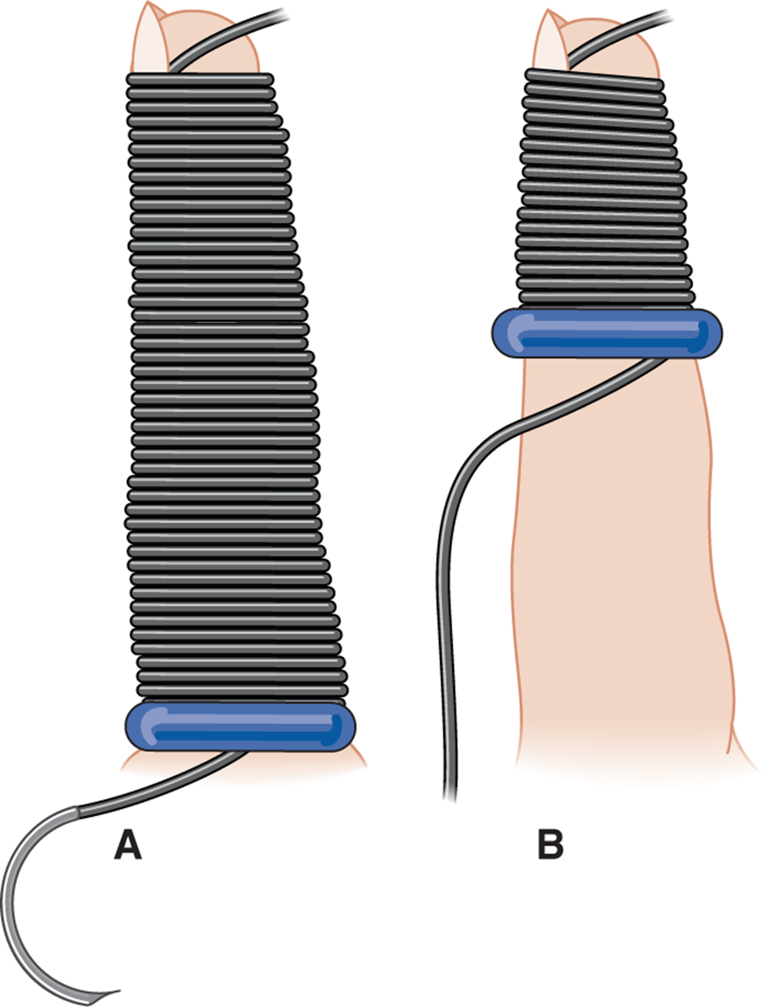 INJURIES OF THE ARM, HAND, FINGERTIP, AND NAIL - EMERGENCY WOUND ...