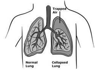 pneumothorax.jpg