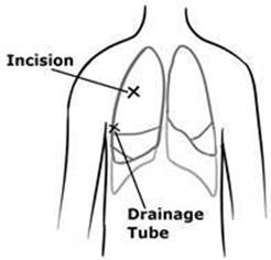 pneumothorax3.jpg