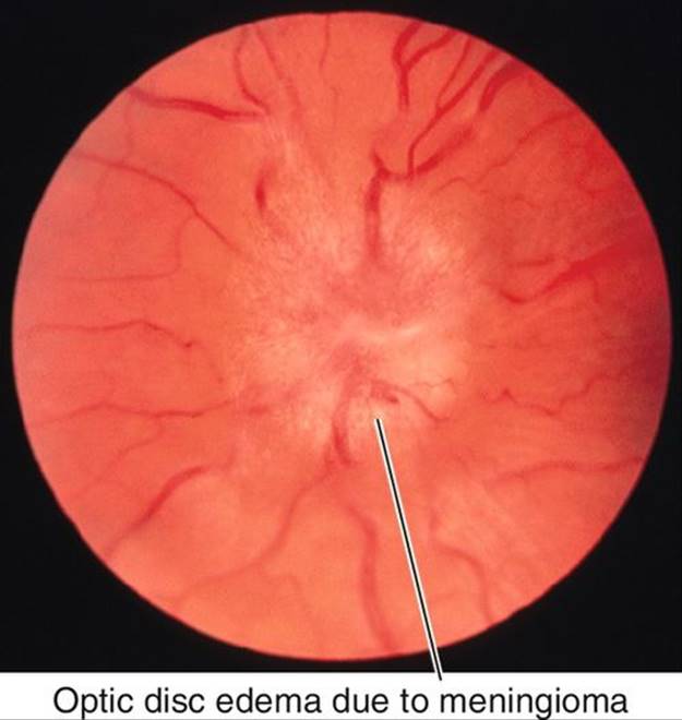 u11-23-9781455776443