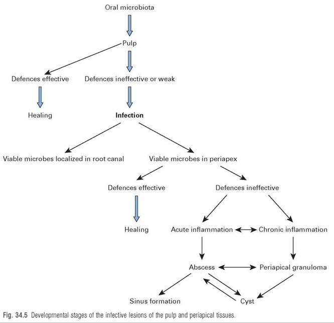 Dentoalveolar and endodontic infections - Essential Microbiology for ...