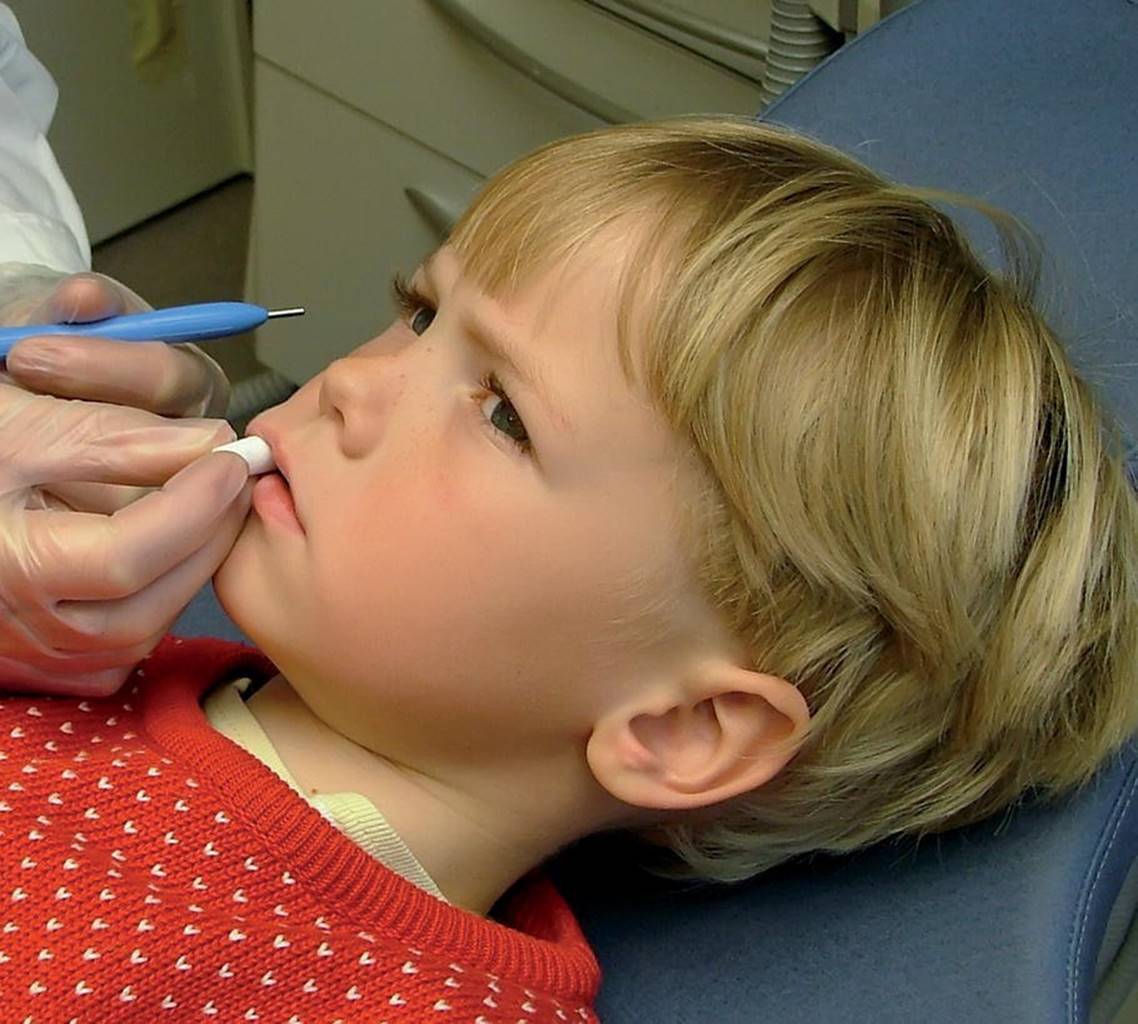 Photo displaying a gloved hand placing fissure sealants on a boy&rsquo;s first permanent molars.