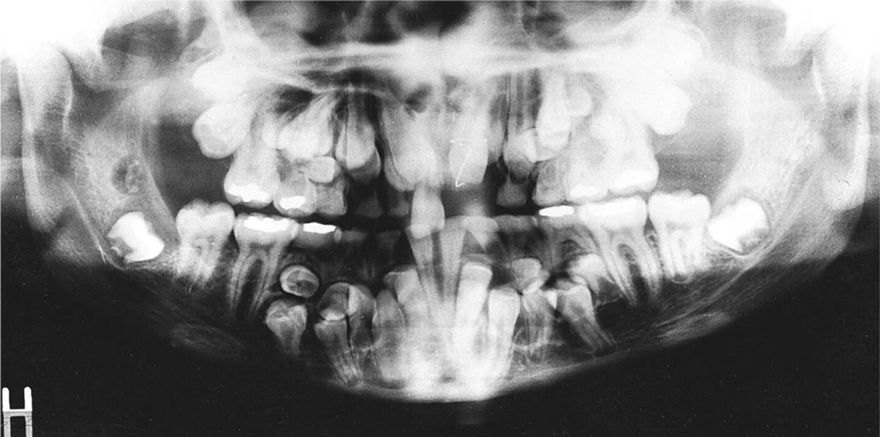 Orthopantomogram displaying supernumerary permanent teeth and arrested eruption of many of the normal permanent teeth of a boy with cleidocranial dysplasia.