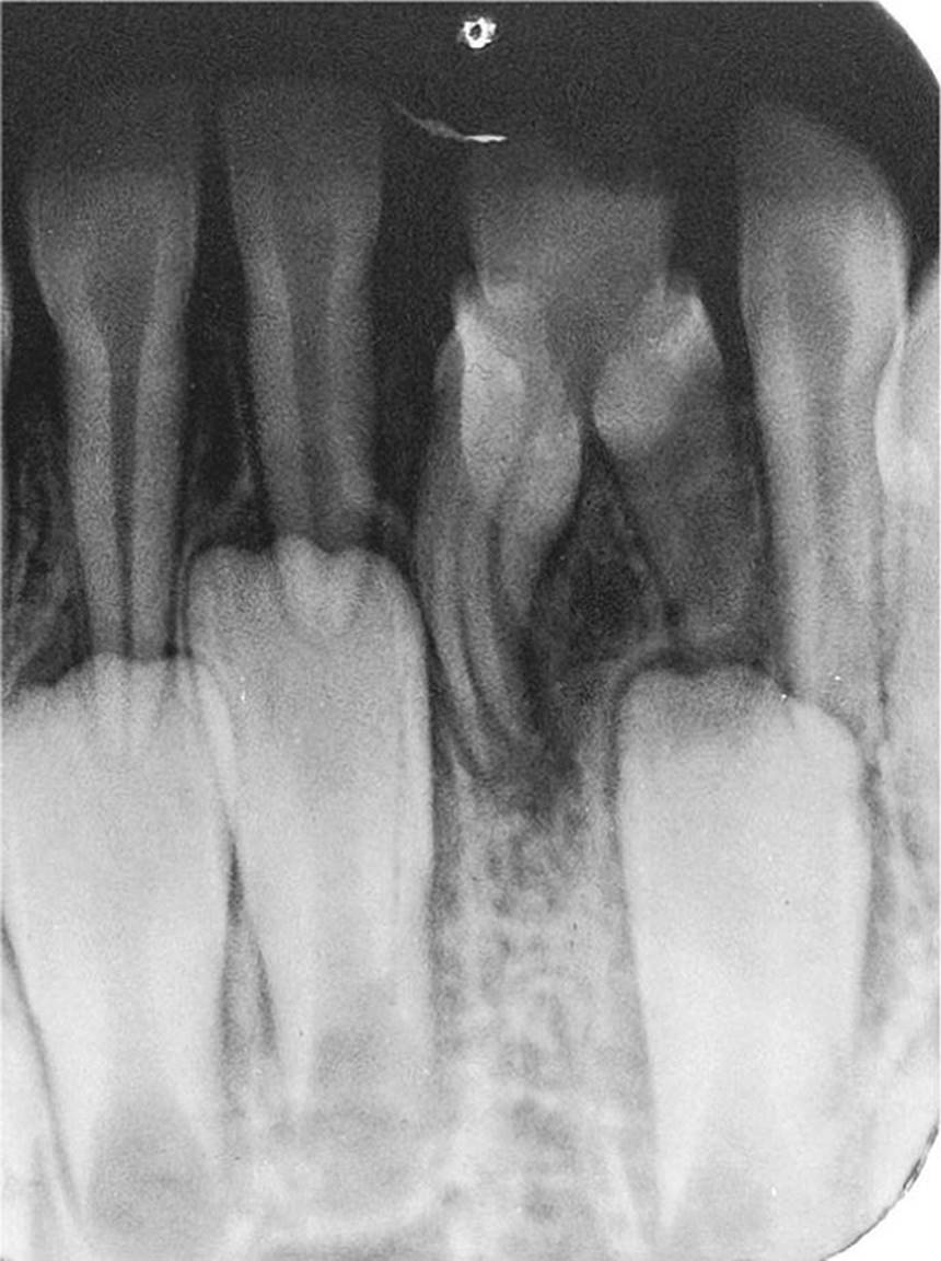 Radiograph of premature development and eruption of dilacerated mandibular central incisor caused by intrusive trauma against primary incisors at 1 year of age.