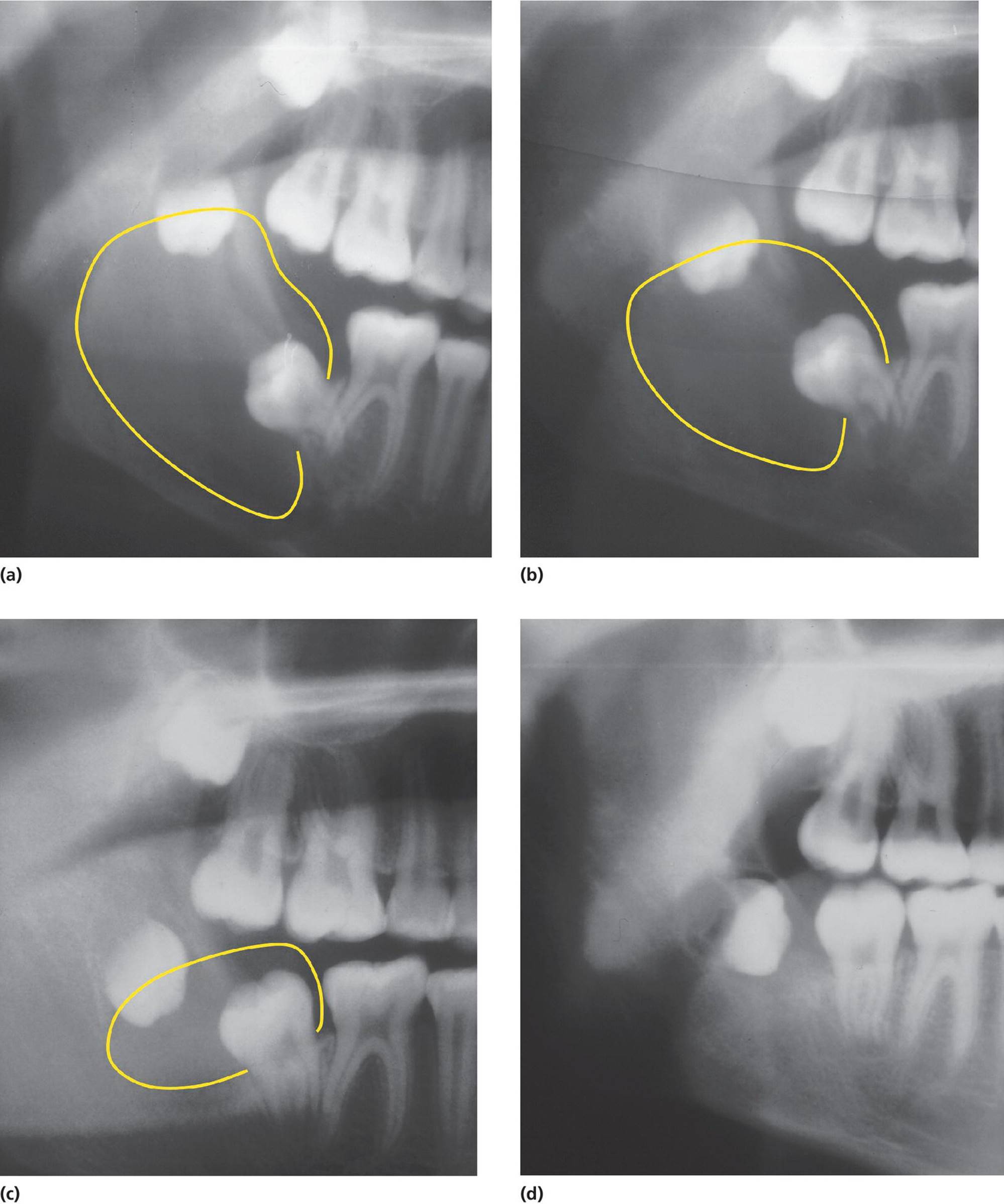 Radiographs of large dentigerous cyst from nonerupted 37 and 38 in mandible ramus (a), cyst reduced (b), with 37 seen in mouth (c), and with 37 in occlusion and 38 removed with minor surgical intervention (d).