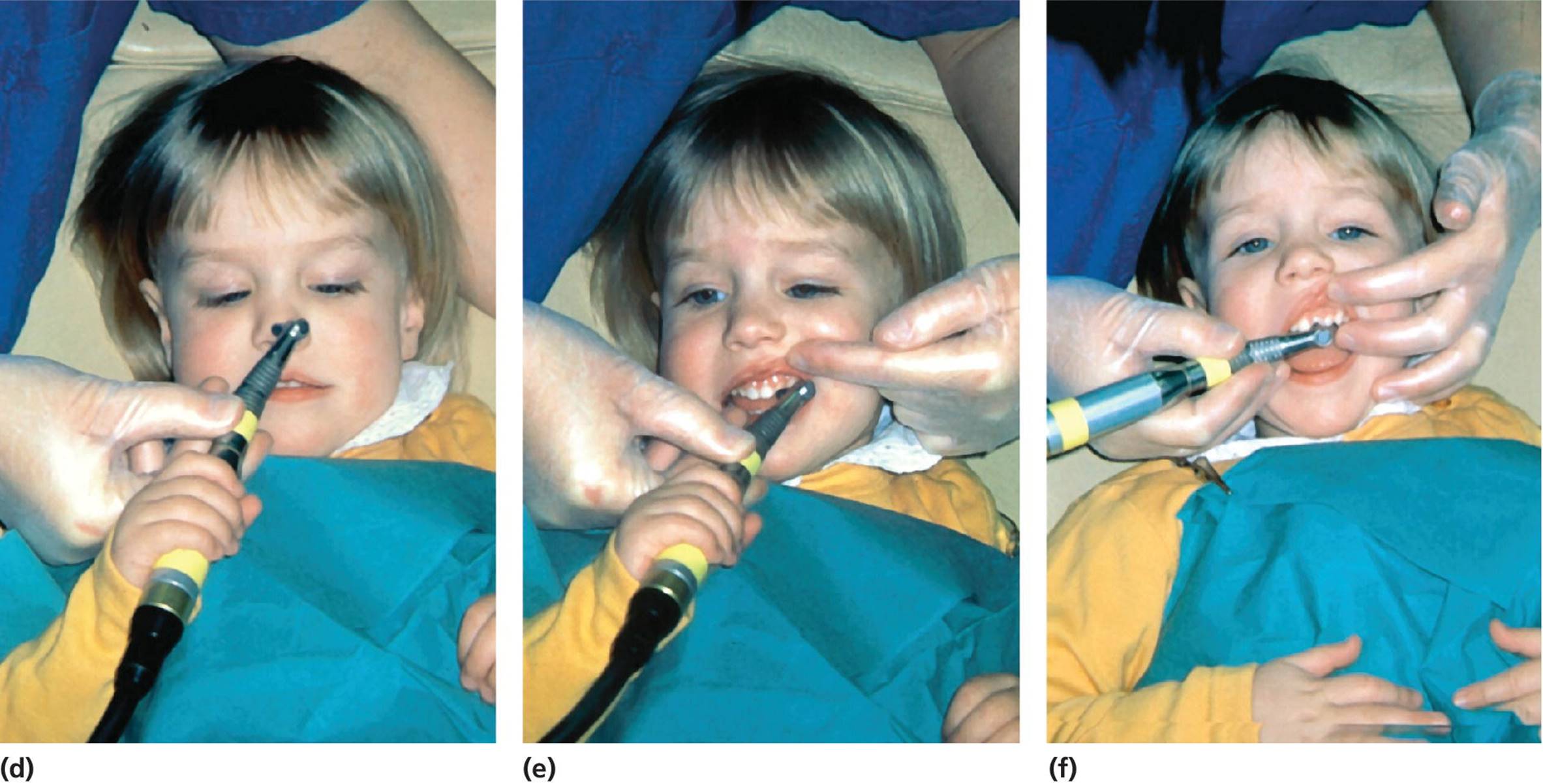 Photos of the same 3-year-old girl at her first dental visit, with low-speed polisher polishing tip of nose (d) and teeth while she is holding it (e) and dentist cleaning her teeth while resting her hands on her stomach (f).