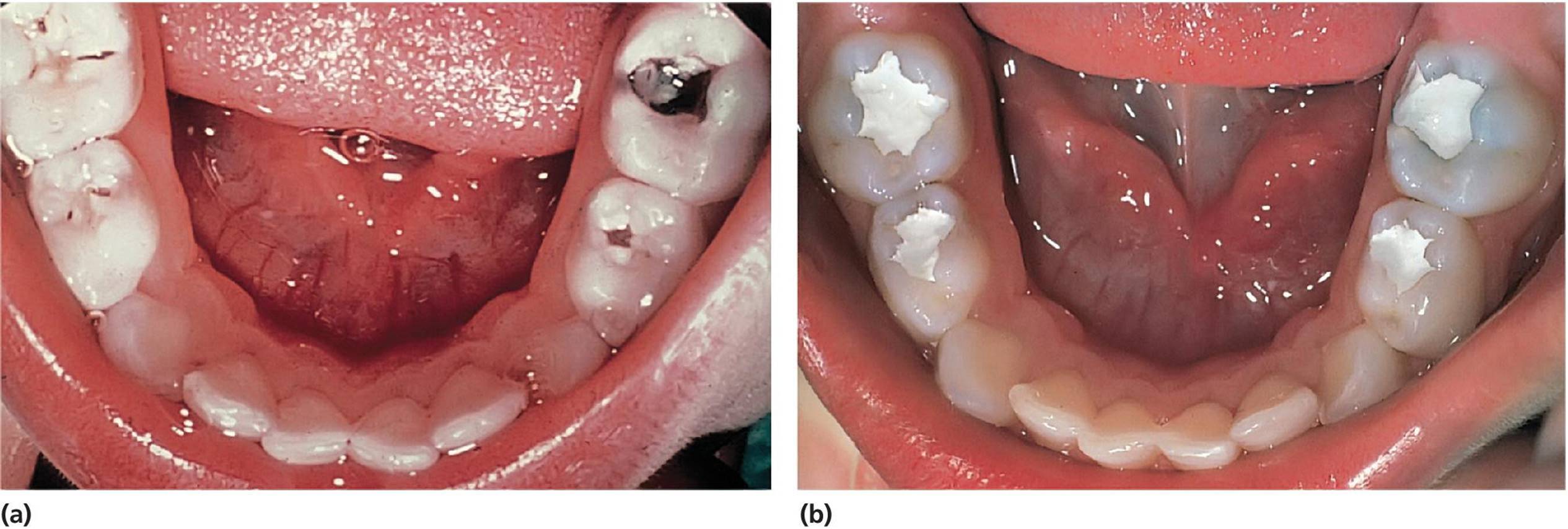 Two photos displaying the mandibular teeth of a 3-year-old boy with high caries activity (left) and after gross excavation of the caries lesions and application of a temporary zinc oxide&ndash;eugenol cement (right).