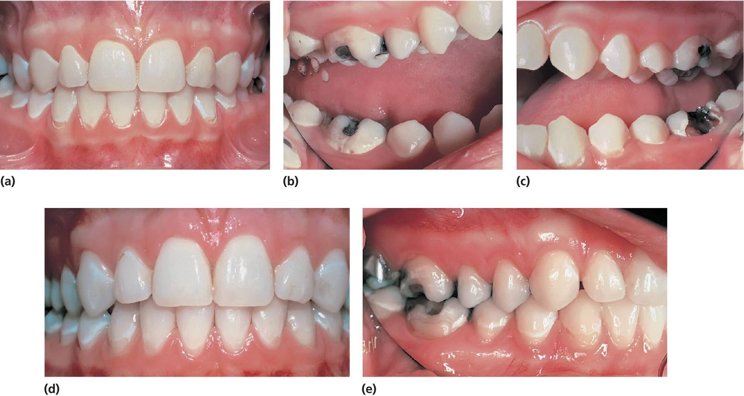 Photos displaying teeth of a 13-year-old girl, with active caries (a&ndash;c), same teeth with adequate caries control, 5 years later (d), and same teeth still with adequate caries control, another 3 years later (e).