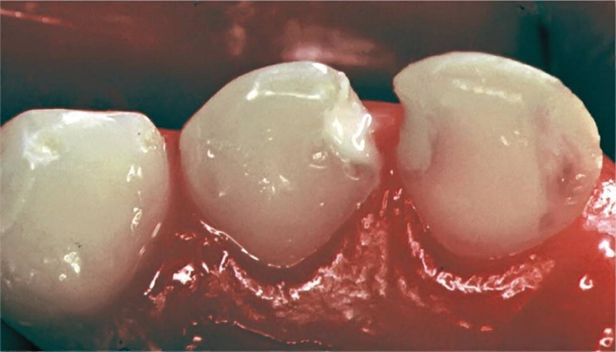 Photo displaying teeth with thin layer of GIC.