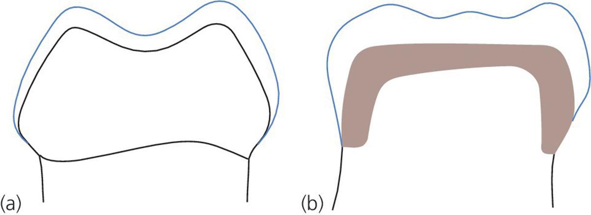 Two illustrations of teeth, depicting the removal of tooth tissue (left) and restoration of the crown (right).