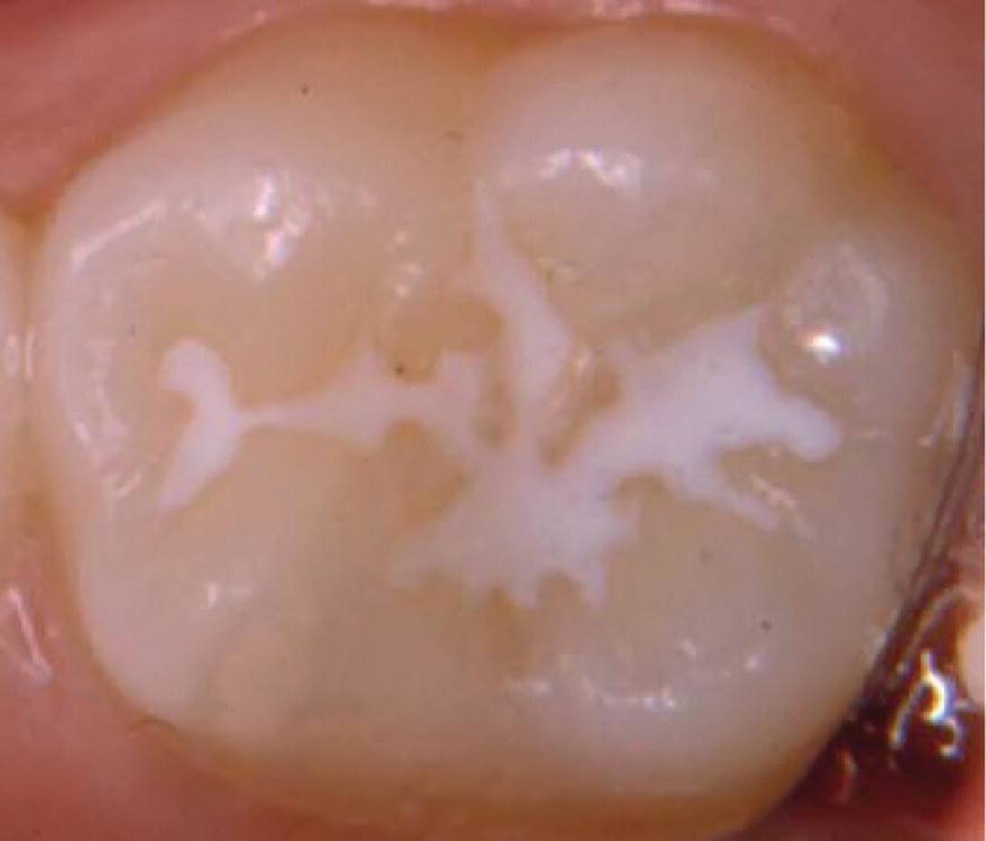 Photo of a molar tooth with fissure sealing covering all parts of the fissure without overfilling and overextension.