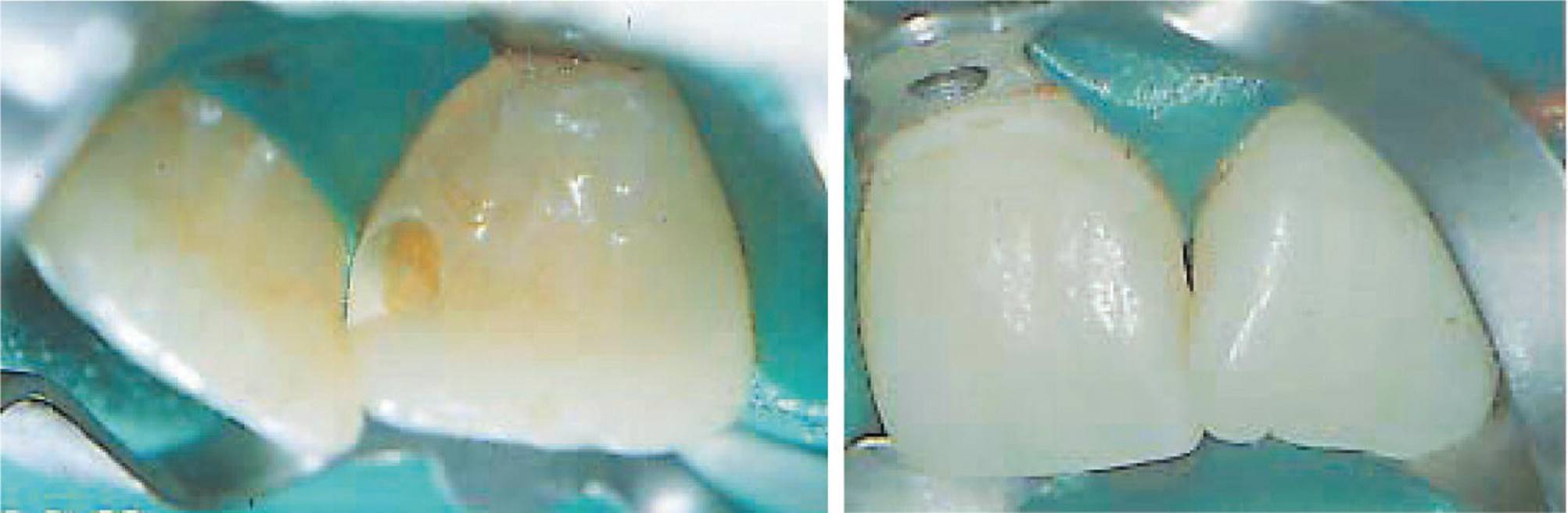 Two photos of the teeth displaying Class III cavity in maxillary incisor.