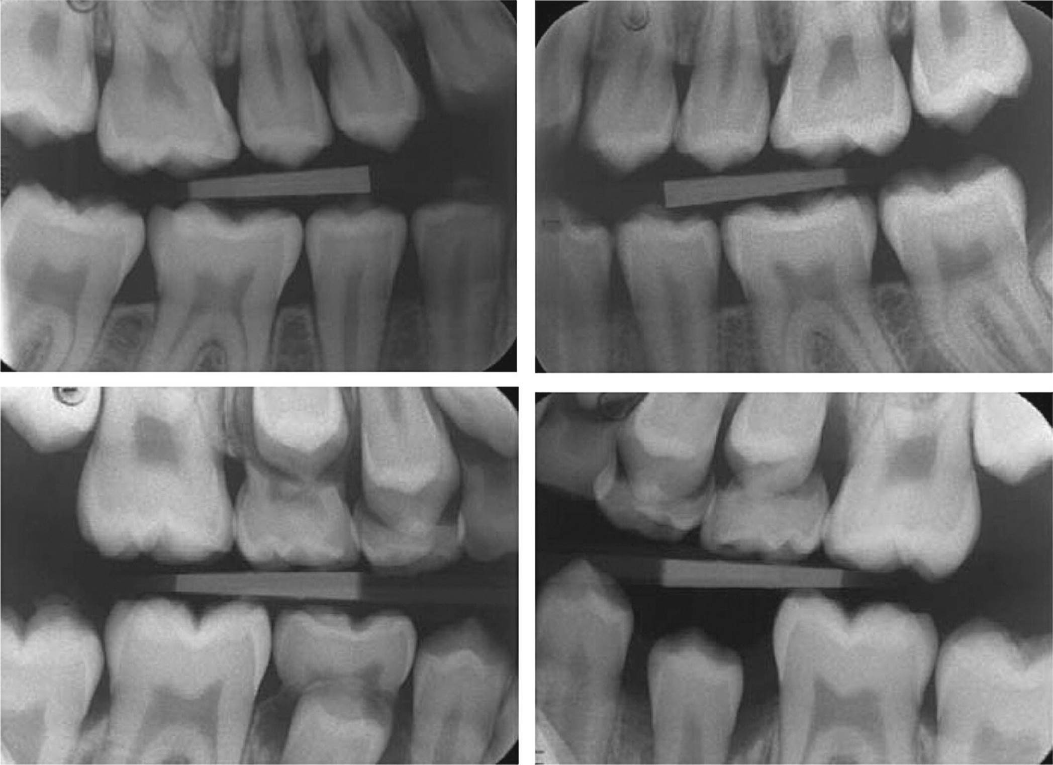 Bitewing radiographs from two 12-year-old children, with one displaying almost fully erupted premolars and second molars (top) while the other is still in the process of shedding primary molars (bottom).