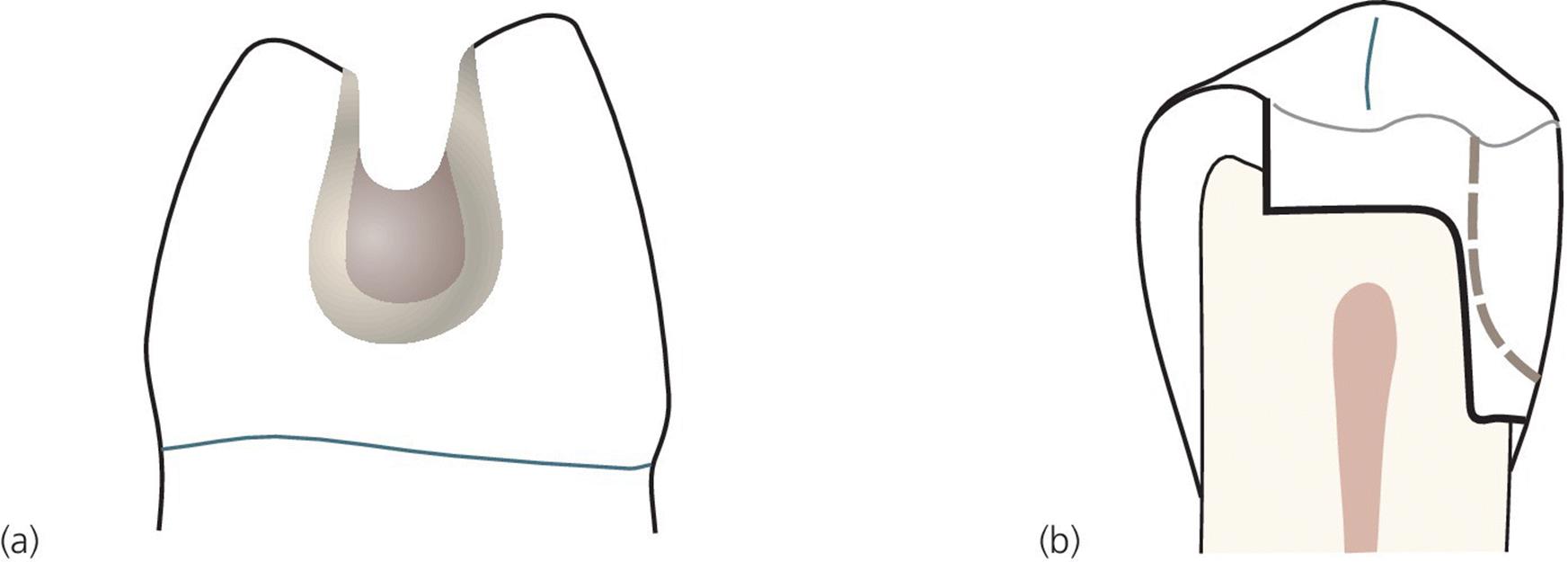 Illustrations of the saucer-shaped cavity design in side view (left) and the cross section in median plane presenting the coverage of the design as depicted by a dotted line.