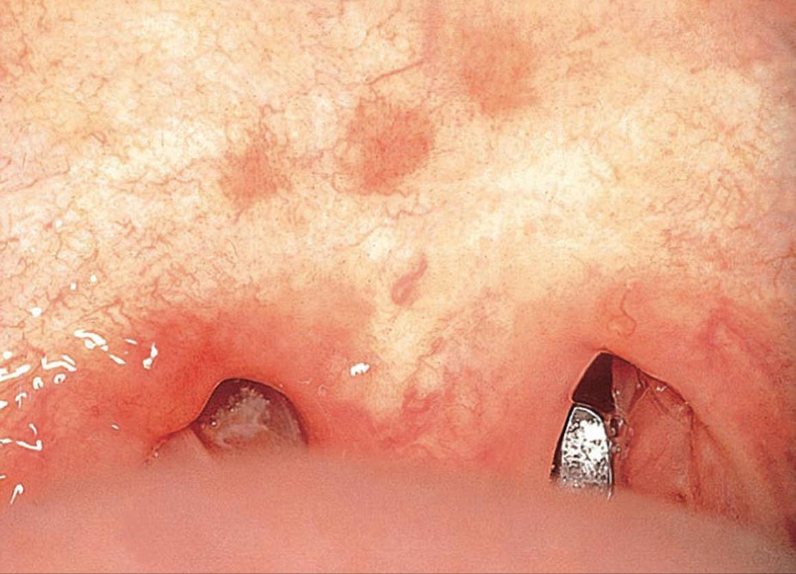 Photo displaying Forschheimer&rsquo;s spots on the soft palate in a child with rubella.