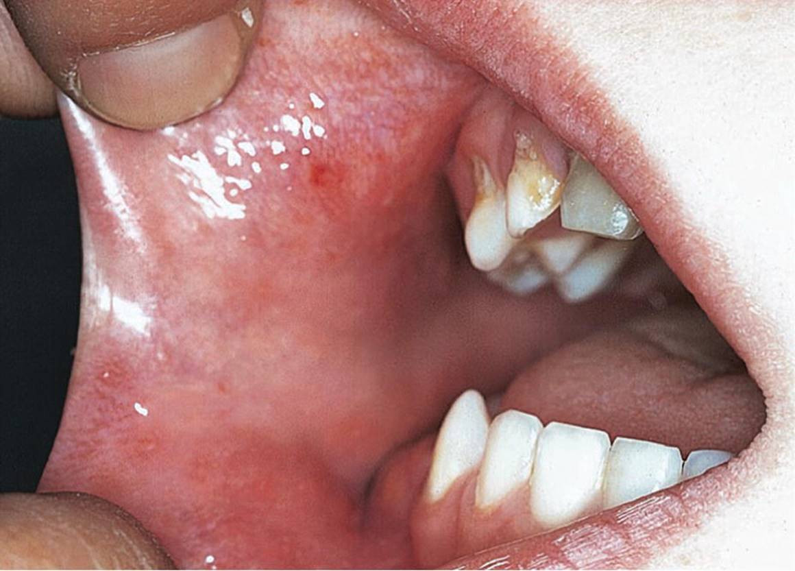 Photo displaying Koplik&rsquo;s spots in the cheek mucosa in a child with measles.