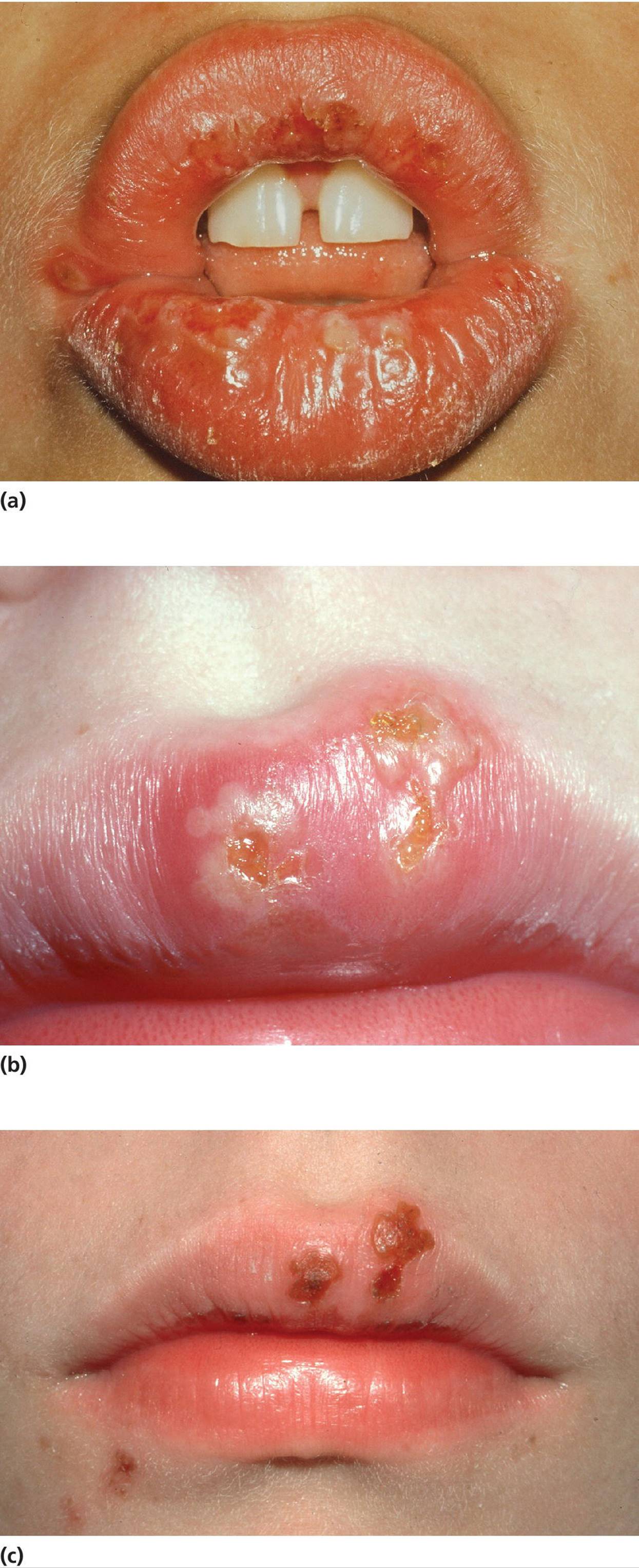 Photo of oral lesions with vesicles and bullae which rapidly burst (top), lesions after 2&ndash;3 days (middle), and crust formation/healing 2 days later (bottom).