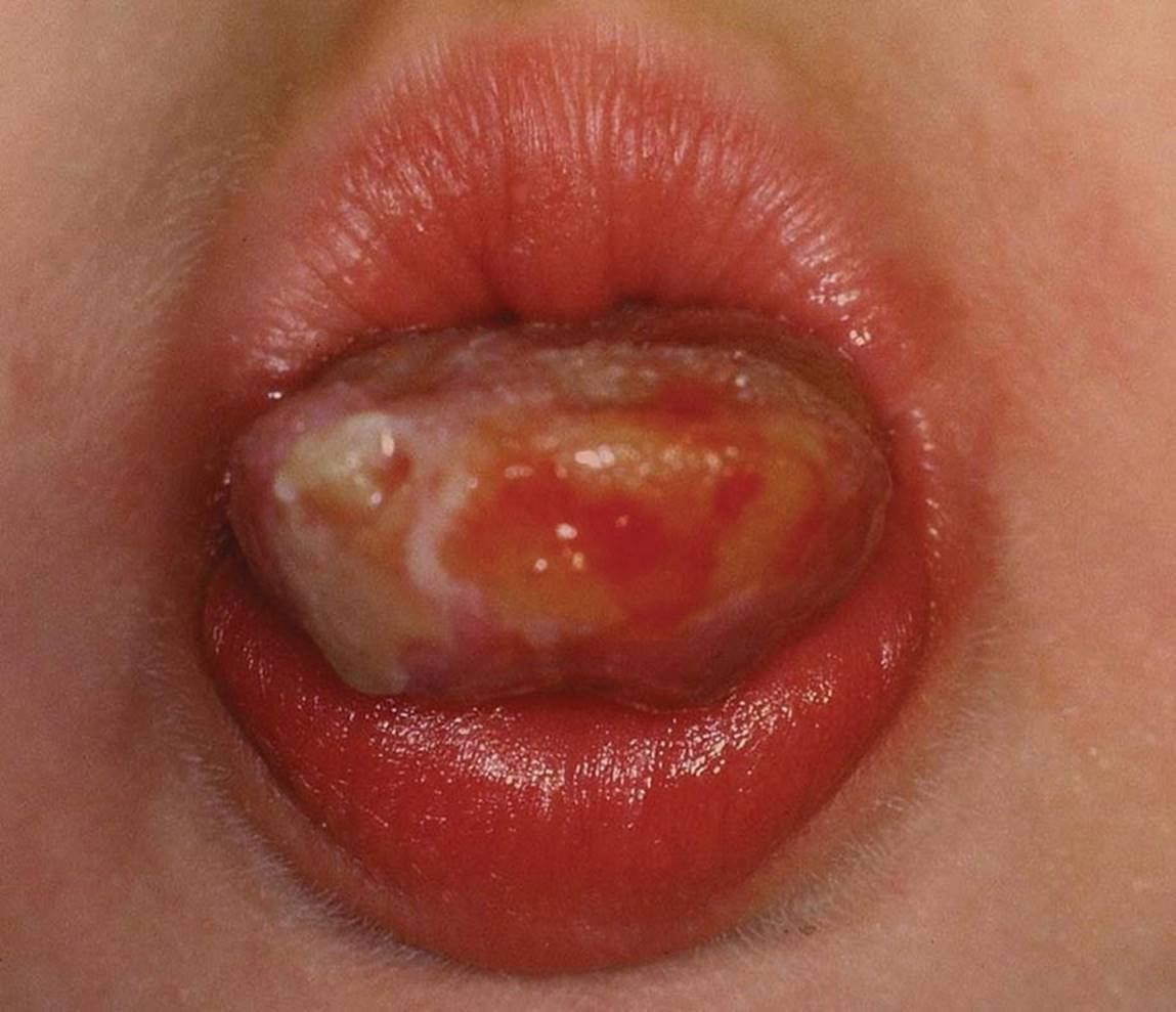 Photo displaying tongue mutilation after local anesthesia.