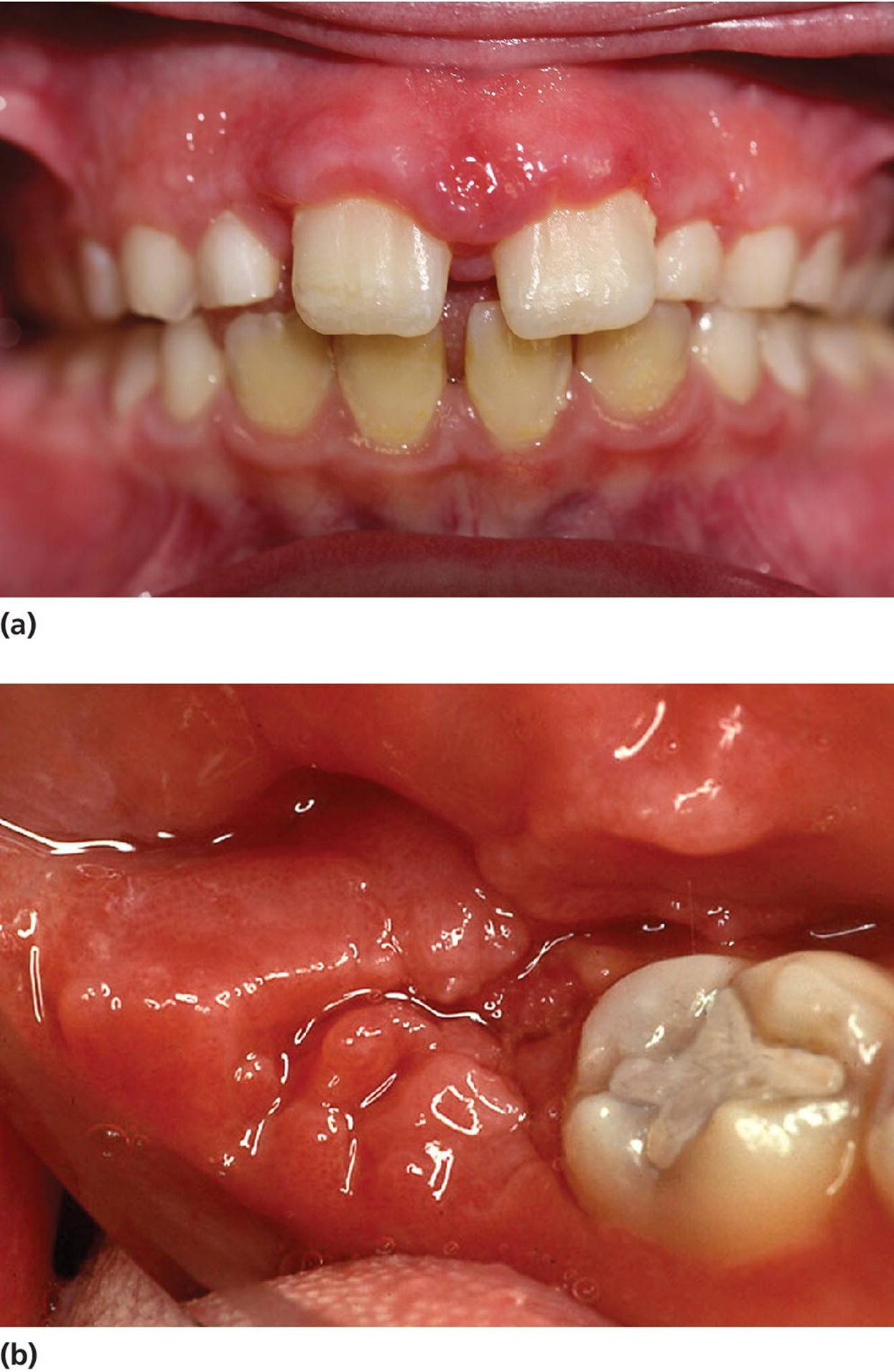 Photo of Crohn&rsquo;s disease displaying gingival characteristics on the incisal region (top) and molar region (bottom).