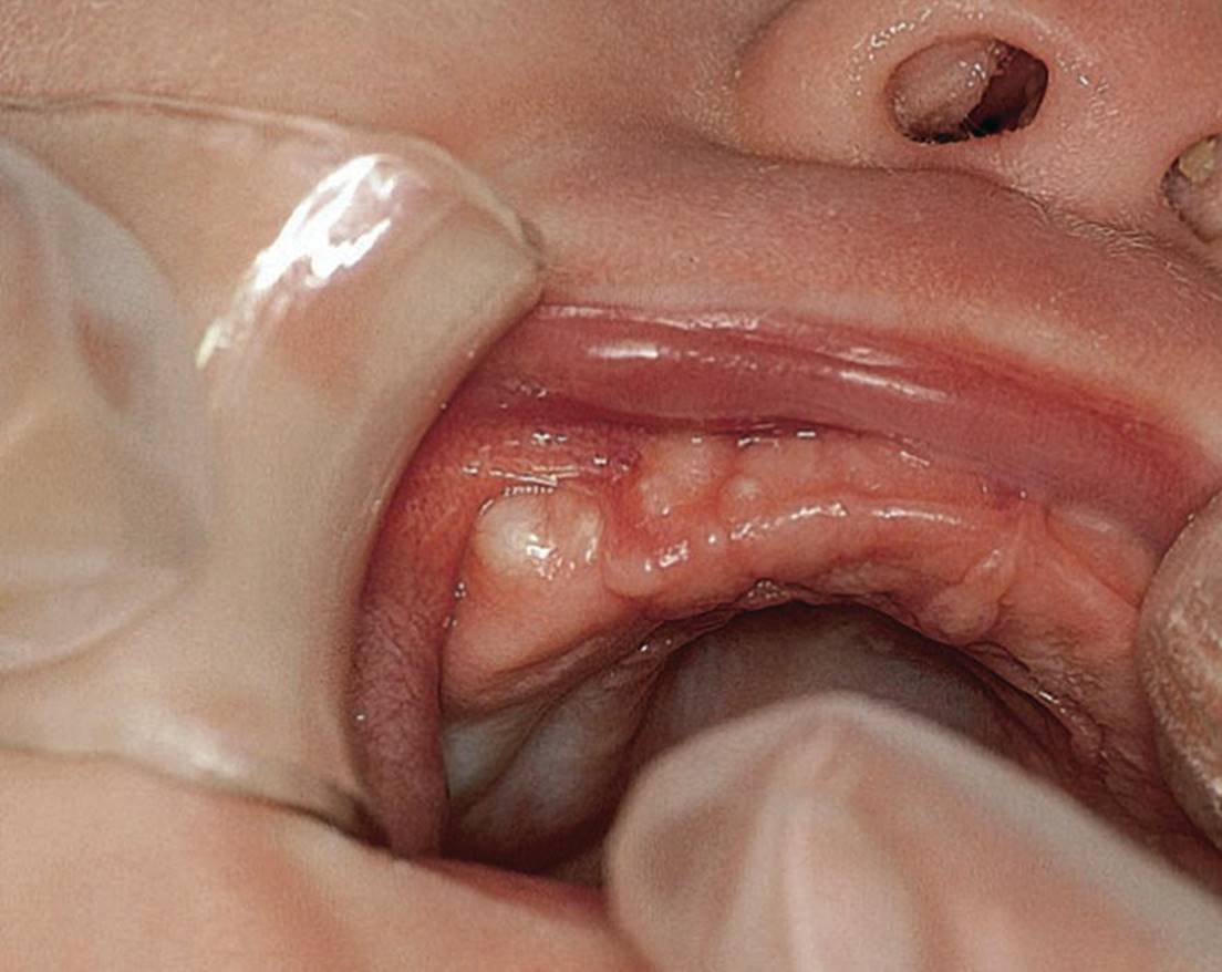 Photo displaying Bohn&rsquo;s nodules on the maxillary gums of a newborn baby.