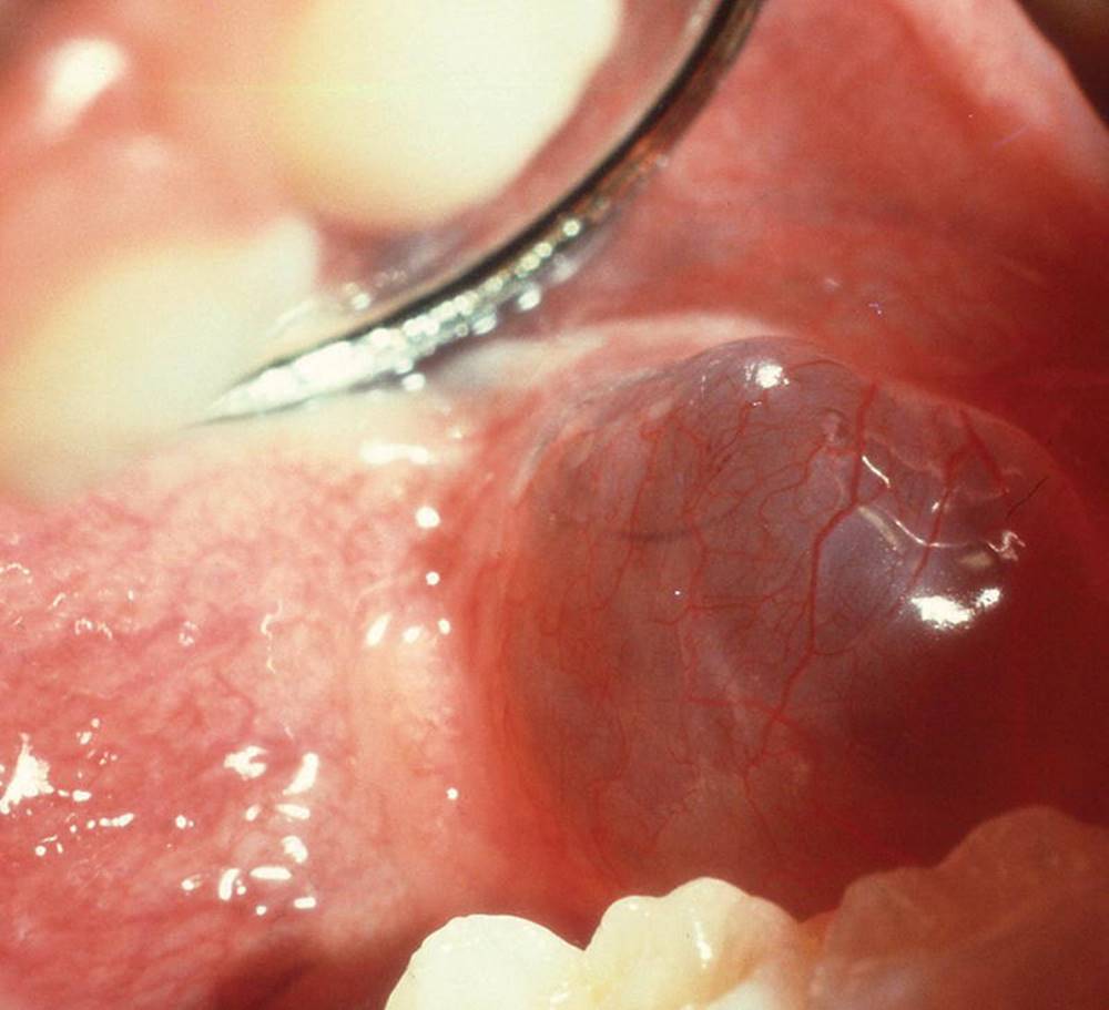 Photo displaying ranula located in the floor of the mouth.