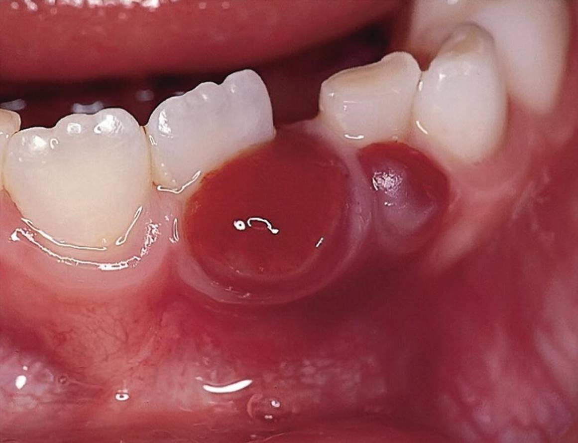 Photo displaying peripheral giant cell granuloma.