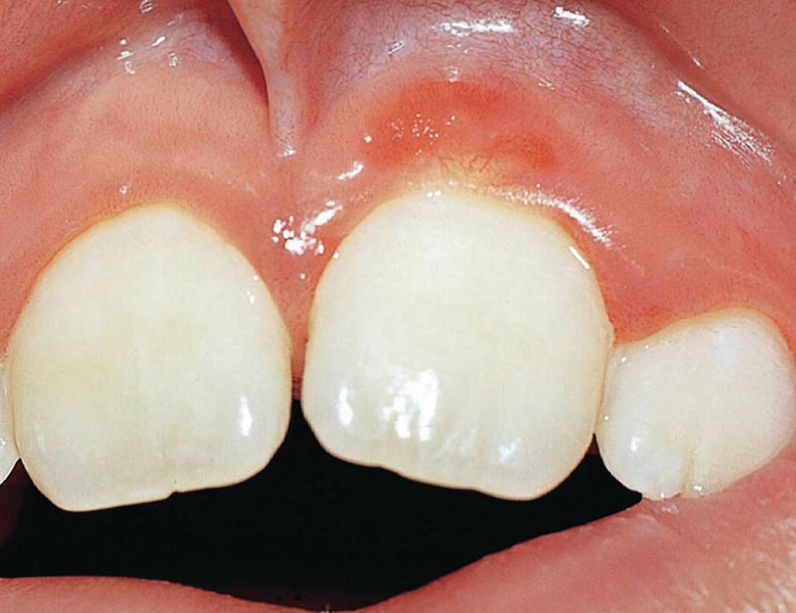 Photo displaying capillary hemangioma.