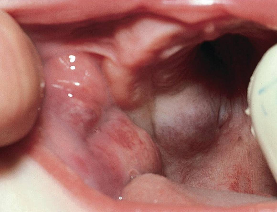 Photo displaying cavernous hemangioma in the palate of a newborn and the capillary hemangioma in the cheek.