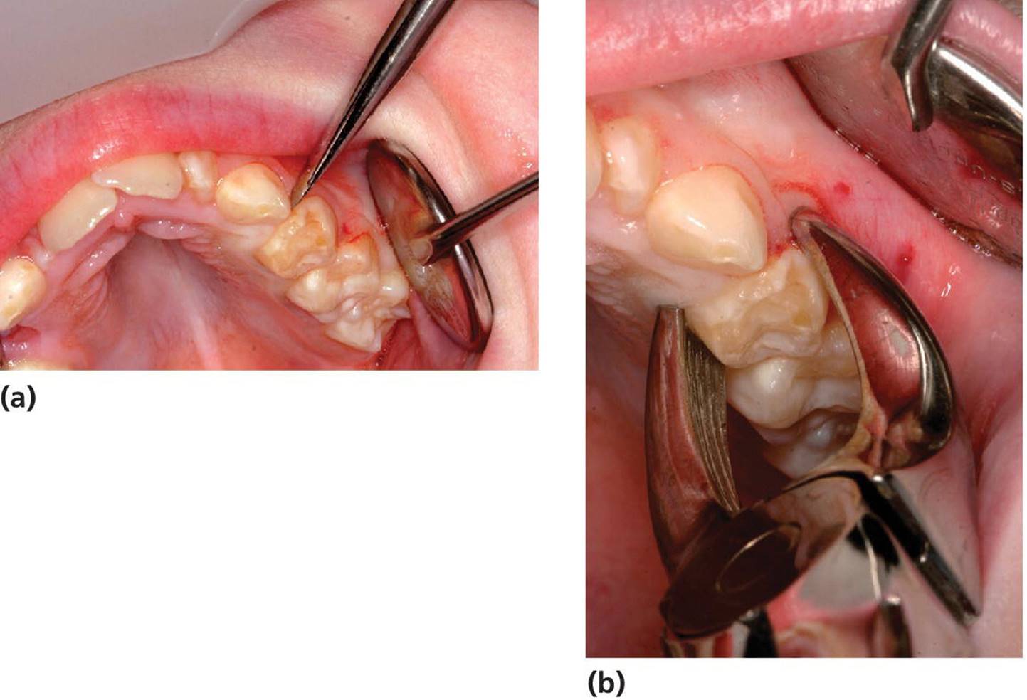 Photos of extraction of primary teeth displaying molars in upper jaw (a,b).