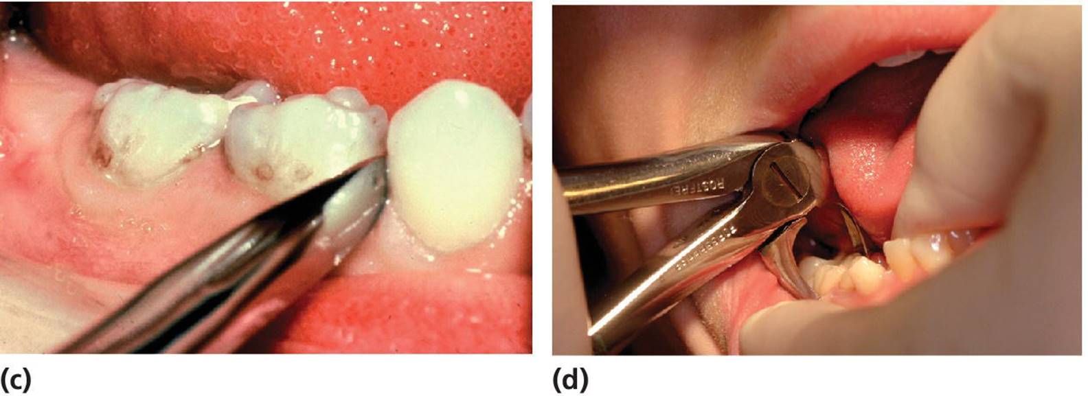 Photos displaying the extraction of primary teeth in the lower jaw.